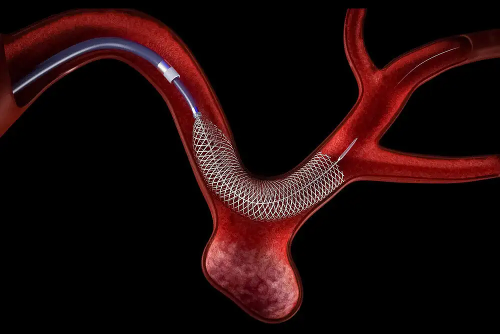 Flow Diverter Placement Procedure Step-by-Step